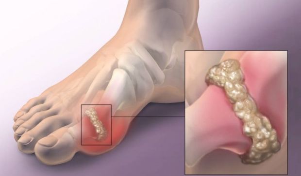 mokracna-kiselina-u-zglobovima-giht-lecenje-i-simptomi