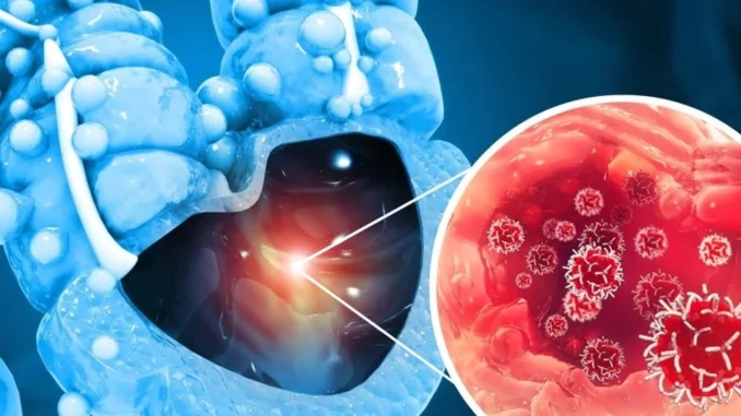 1772718057-rak-debelog-crijeva-690x480